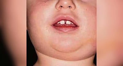 பொன்னுக்கு வீங்கி பாதிப்பு: தற்காத்துக் கொள்ள அறிவுறுத்தல்