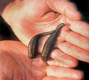 ஆயுள் காக்கும் ஆயுர்வேதம்: கெட்ட ரத்​தத்​தைக் குடிக்க அட்​டைப் பூச்சி!