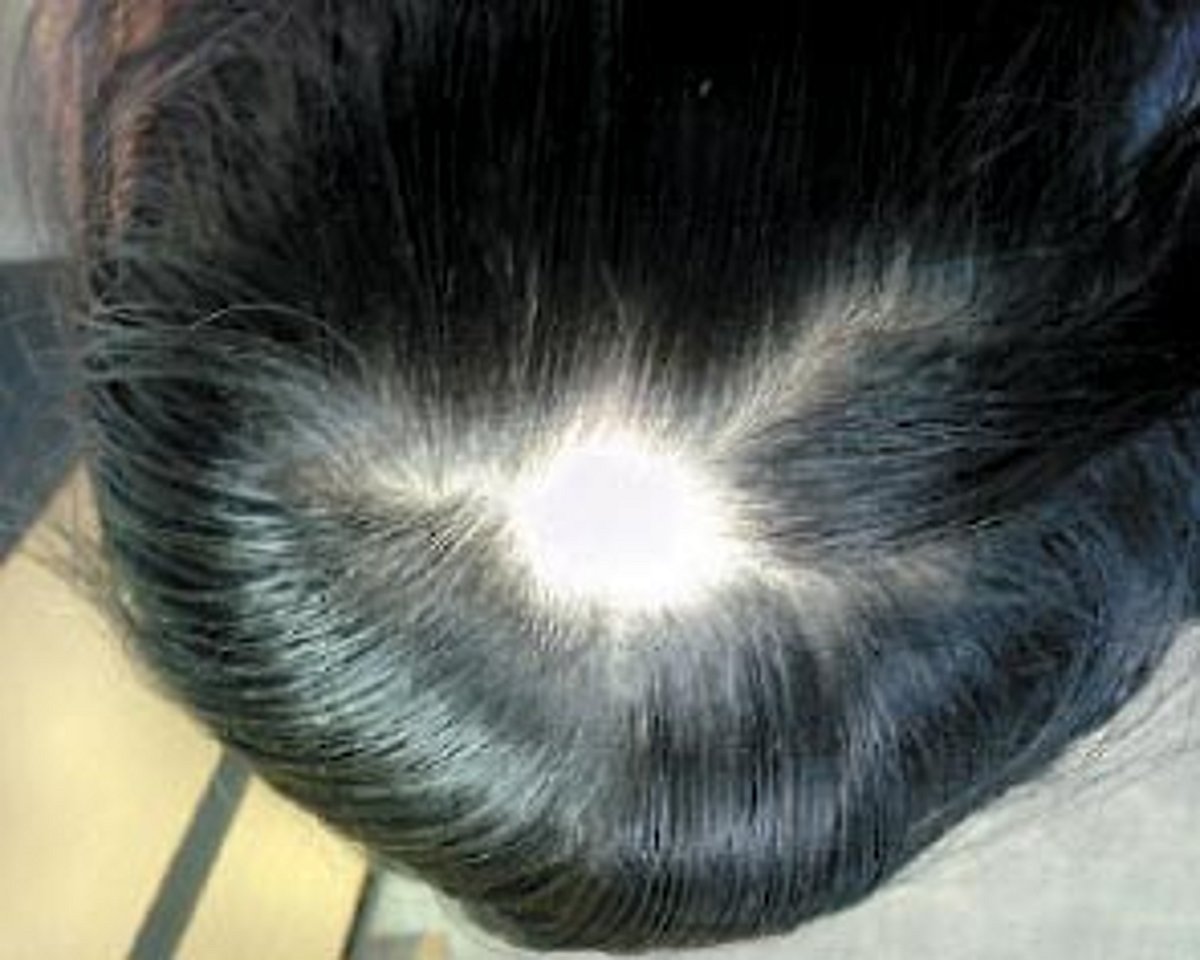 ஆயுள் காக்கும் ஆயுர்வேதம்: தலையில் புழு வெட்டு!