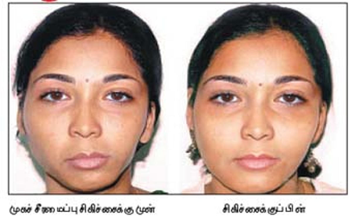 மருத்துவம்: தேவையான வடிவத்தில் எலும்பை வளர்க்க முடியும்!