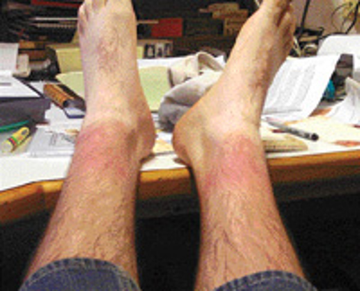 ஆயுள் காக்கும் ஆயுர்வேதம்: மரத்துப் போன கால்கள்!