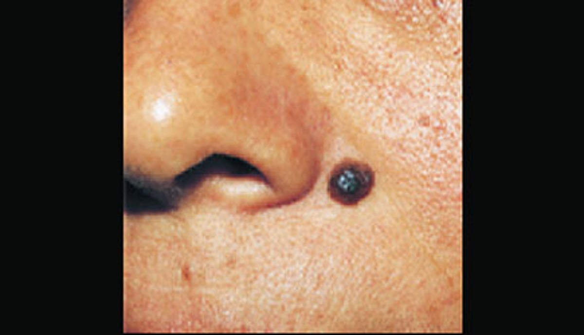 ஆயுள்காக்கும் ஆயுர்வேதம்: முகத்தில் ஏற்படும் கறுப்பு உருண்டை!