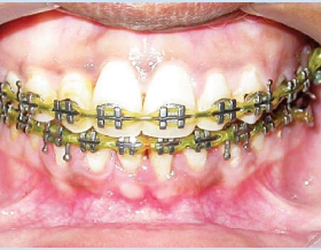 சீரற்ற பற்களுக்கு "கிளிப்' வயது தடையில்லை 
