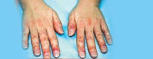 ஆயுள்காக்கும் ஆயூர்வேதம்: உடல் முழுவதும் அரிப்பு!