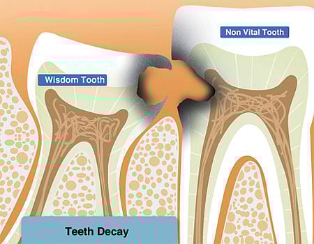 ஈறுகளில் இரத்தம் கசிவது ஏன்?