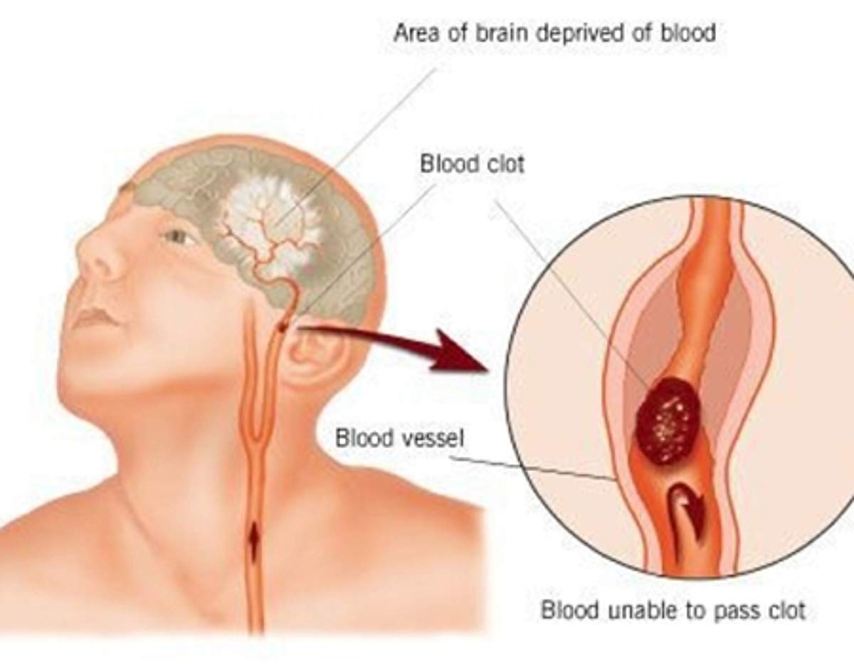 பெங்களூருவில் இந்த நோய் அதிகம் பரவி வருகிறது: காரணம் டென்ஷன்தானாம்!