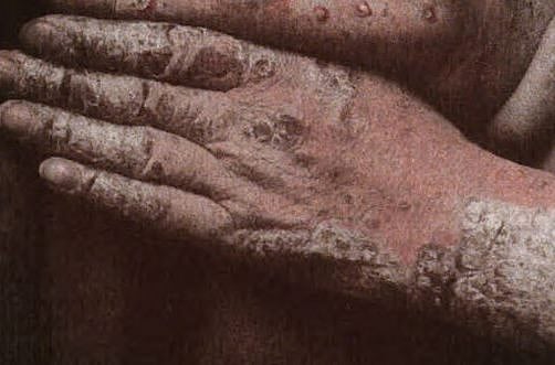 சோரியாஸிஸ் நோயாளிகளுக்கு மகிழ்ச்சியான செய்தி! விரைவில் வருகிறது ஒரு புது மருந்து