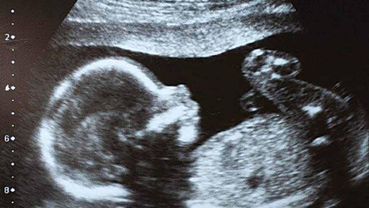 கருவிலேயே அழிக்கப்படும் பெண் சிசுக்கள்: துணைபோகும் மருத்துவர்கள்