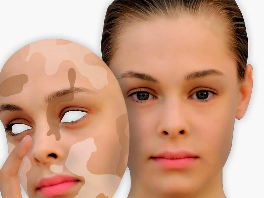 வெண்புள்ளி வியாதியை விரட்டும் ஹோமியோபதி மருந்துகள்