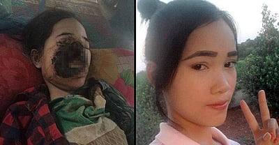 முகத்தின் சதையை தின்னும் வினோத பாக்டீரியா: கம்போடிய இளம்பெண்னுக்கு நேர்ந்த விபரீதம்!