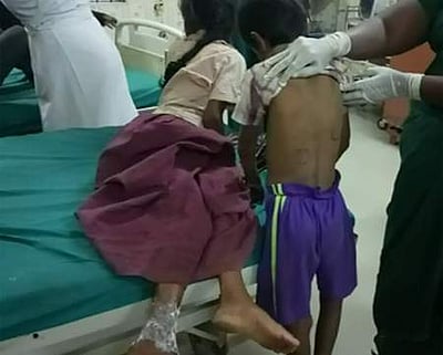 பெற்ற தாயே குழந்தைகளுக்கு உடல் முழுவதும் சூடு வைத்த கொடூரம்: தாய் மற்றும் கணவன் கைது