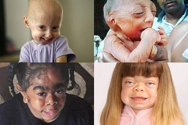 குழந்தைகளைத் தாக்கும் தீர்க்கமுடியாத சில அரிய நோய்கள்!