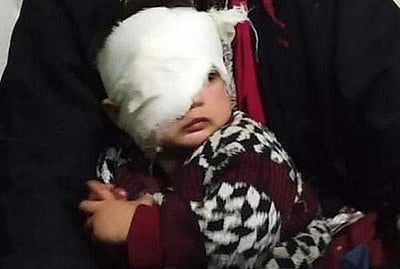 காஷ்மீரில் ரப்பர் குண்டு பாய்ந்து பார்வைக்காக போராடும் 20 மாத குழந்தை!