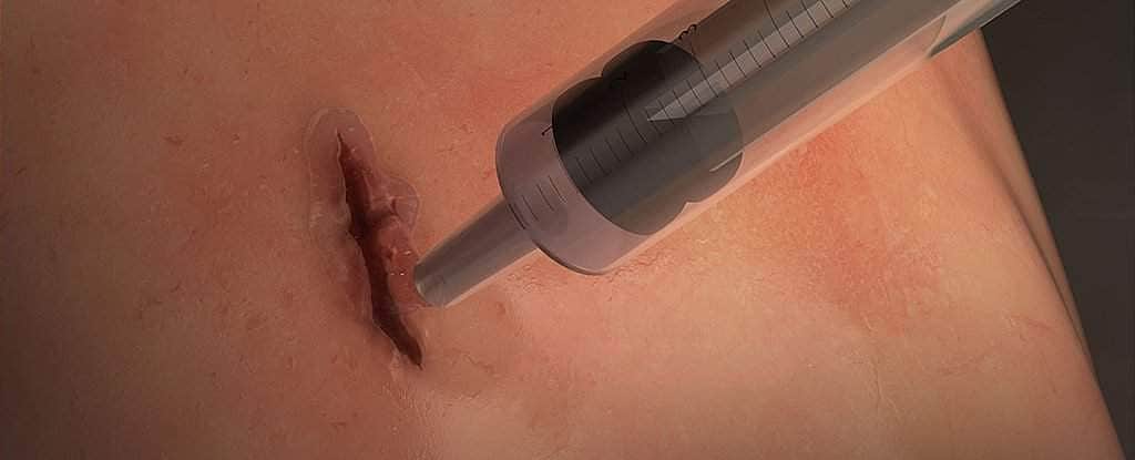 அறுவை சிகிச்சை காயங்களை 60 நொடிகளில் மறைய வைக்கும் அற்புத பிசின் கண்டுபிடிப்பு!