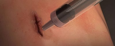 அறுவை சிகிச்சை காயங்களை 60 நொடிகளில் மறைய வைக்கும் அற்புத பிசின் கண்டுபிடிப்பு!