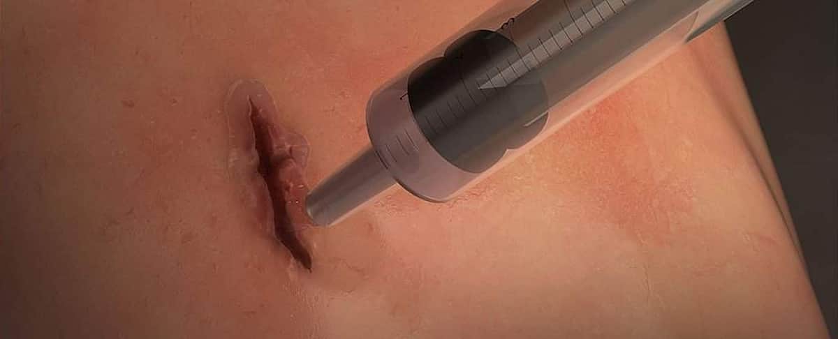 அறுவை சிகிச்சை காயங்களை 60 நொடிகளில் மறைய வைக்கும் அற்புத பிசின் கண்டுபிடிப்பு!