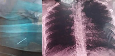 கர்ப்பிணியின் உடலுக்குள் புகுந்த உடைந்த ஊசி! அரசு மருத்துவமனை அவலம்!