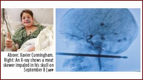 மூக்கில் குத்தி பின்கழுத்தில் வெளியே வந்த ஸ்பூன்: உயிர் பிழைத்த அதிசய சிறுவன்