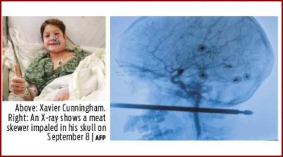 மூக்கில் குத்தி பின்கழுத்தில் வெளியே வந்த ஸ்பூன்: உயிர் பிழைத்த அதிசய சிறுவன்