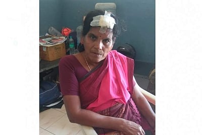 பொள்ளாச்சி: மருமகள் கடித்ததில் மாமியாருக்கு தலையில் படுகாயம்