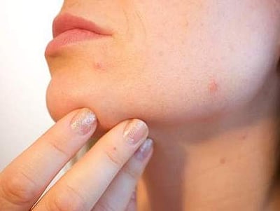 சருமத்தில் கரும்புள்ளிகளை நீக்கும் எளிய முறை