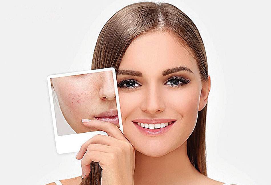 முகத்தில் உள்ள தழும்புகள் மறைய!