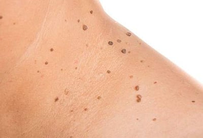 சருமத்தின் அழகைக் கெடுக்கும் மருக்களைப் போக்க...