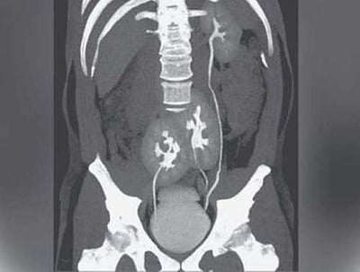 கடுமையான முதுகுவலியால் அவதிப்பட்டு வந்தவருக்கு 3 சிறுநீரகங்கள்: மருத்துவர்கள் ஆச்சரியம்