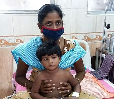 2 வயது குழந்தையின் நுரையீரலில் சிக்கிய நிலக்கடலையை அகற்றிய அரசு மருத்துவா்கள்