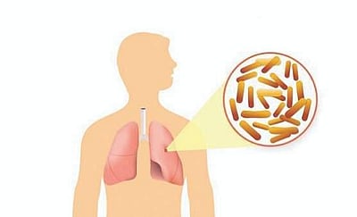கவனம், காசநோய்ப் பரவல்! |  காசநோய் தொற்றுப் பரவல் குறித்த விழிப்புணர்வு  தலையங்கம்