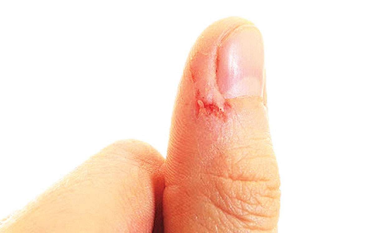 நகச்சுத்தி குணமாக...