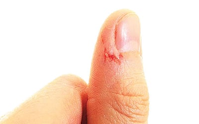 நகச்சுத்தி குணமாக...