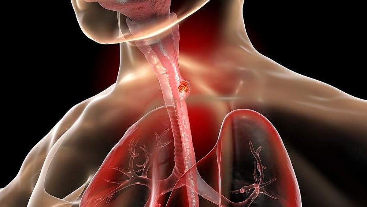 அறிவியல் ஆயிரம்: ஸ்டென்ட் மூலம் புற்றுநோய் சிகிச்சை - புதிய கண்டுபிடிப்பு