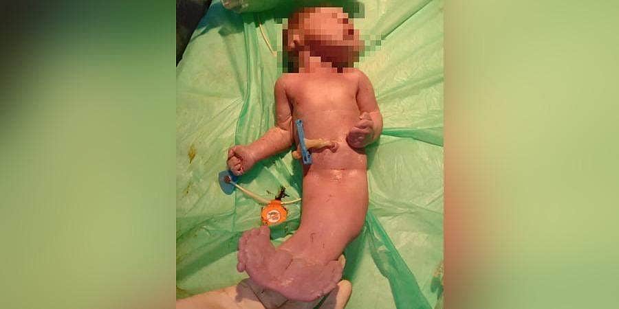 மீன் போன்ற உடலுடன் பிறந்த குழந்தை: 2 மணி நேரத்தில் உயிரிழப்பு