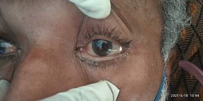 தமிழகத்தில் கரும்பூஞ்சை தொற்றுக்கு முதல் உயிரிழப்பு