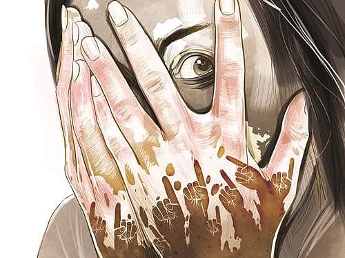 வெண்புள்ளிகள் என்பது வெறும் நிறமிழப்பே!