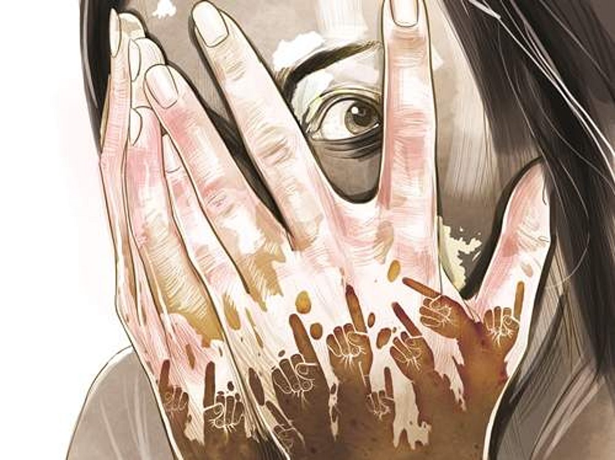 வெண்புள்ளிகள் என்பது வெறும் நிறமிழப்பே!