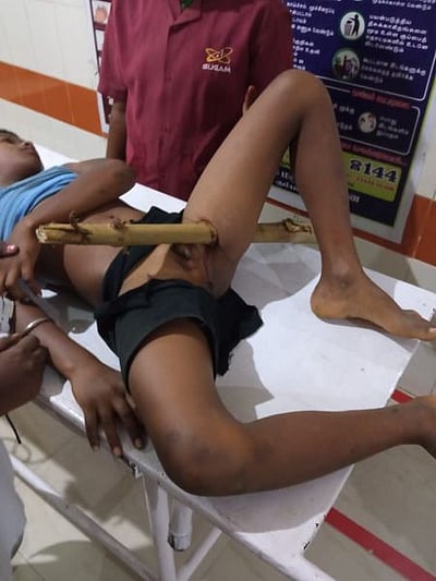 சிறுவனின் தொடையில் பாய்ந்த குச்சியை அகற்றிய அரசு மருத்துவா்கள்