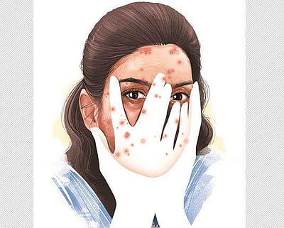 முகத்தில் கரும்புள்ளிகள், கருந்திட்டுகள் மறைய எளிய டிப்ஸ்!