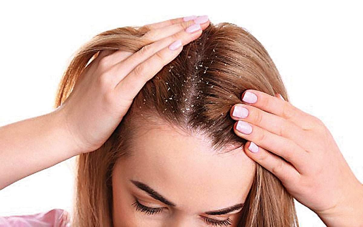 பொடுகினை அழிக்கும் மூலிகைகள்!