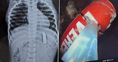 சிறுவன் வயிற்றில் ரிமோட் பேட்டரி! 20 நிமிடங்களில் அகற்றிய மருத்துவர்கள்