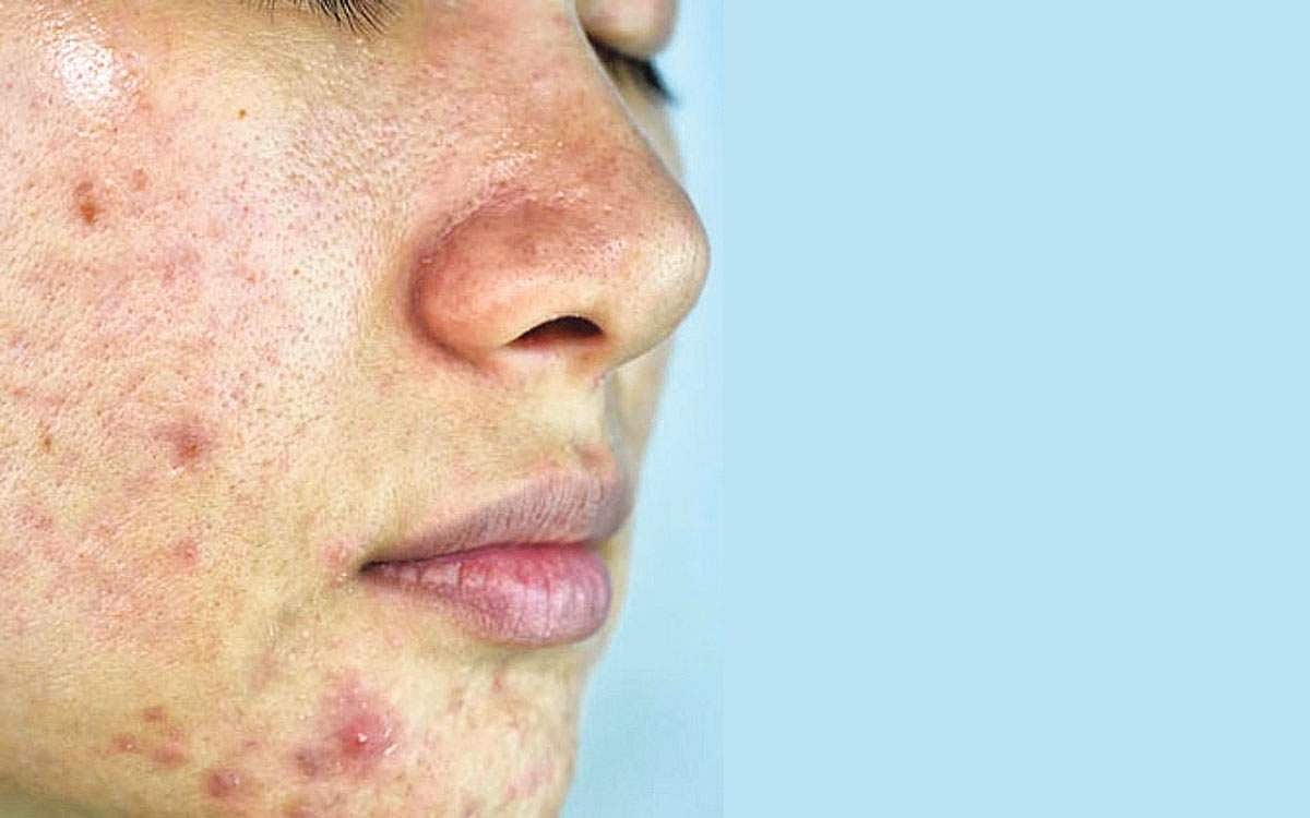 ஆயுள் காக்கும் ஆயுர்வேதம்: ரத்தம் கெடுதல்... தோலில் பிரச்னை!