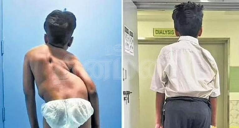 முதுகு தண்டுவட சிதைவால் பாதிக்கப்பட்ட சிறுவனுக்கு கிடைத்தது மறுவாழ்வு