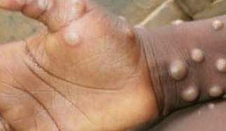 அமெரிக்காவை தொடர்ந்து பிரான்ஸ், ஜெர்மனியிலும் பரவியது ‘குரங்கு அம்மை’ நோய்