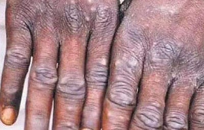 நாட்டில் குரங்கு அம்மை நோய் இதுவரை கண்டறியப்படவில்லை: மத்திய அரசு