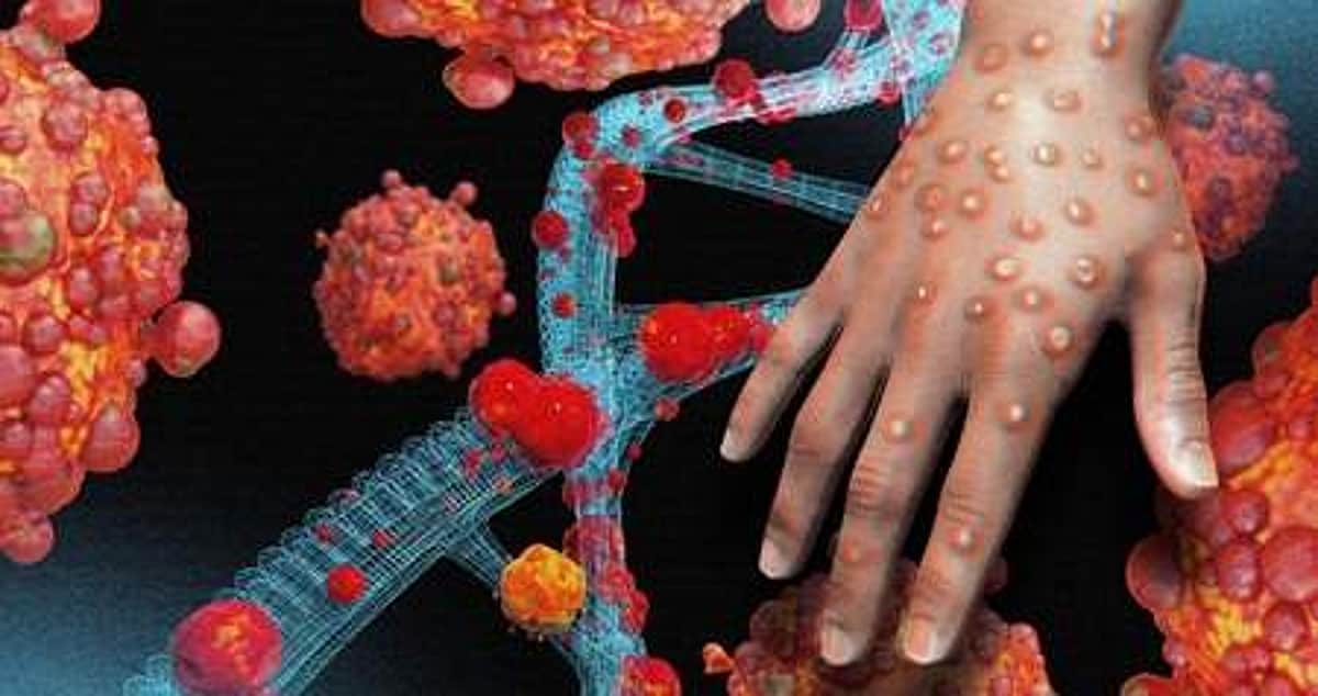 அடுத்த அச்சுறுத்தல்! | குரங்கு அம்மை தீநுண்மி குறித்த தலையங்கம்