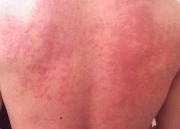 சுகம் தரும் சித்த மருத்துவம்: ஒவ்வாமை, கடி நஞ்சினை நீக்குமா நாகவல்லி…?