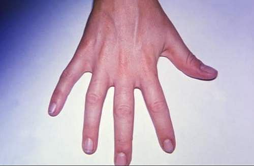 சுகம்தரும் சித்த மருத்துவம்: முடக்கும் மூட்டுவலிக்கு நிவாரணம் அளிக்குமா ‘அரத்தை’…?