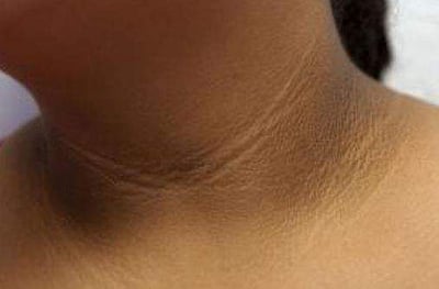 கழுத்தில் உள்ள கருமையைப் போக்க வேண்டுமா?