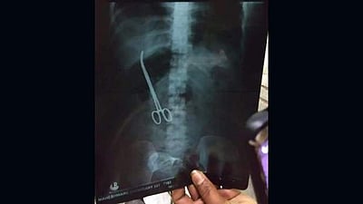 12 ஆண்டுகளாக வயிற்றில் கத்தரிக்கோல்: பெண்ணுக்கு ரூ.10 லட்சம் இழப்பீடு